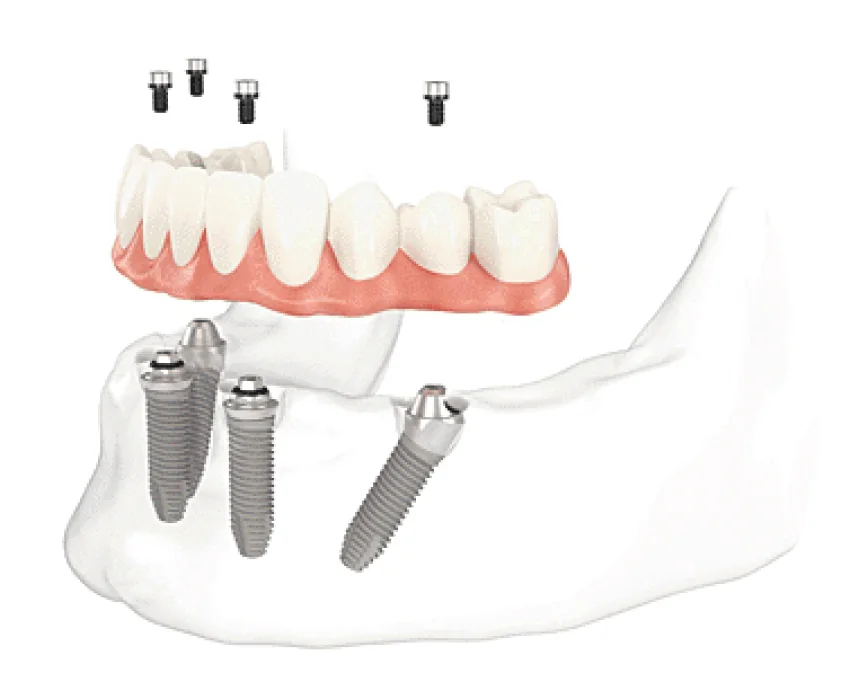 Render 3D de carga imediata: prótese fixa sobre 4 implantes na mandíbula