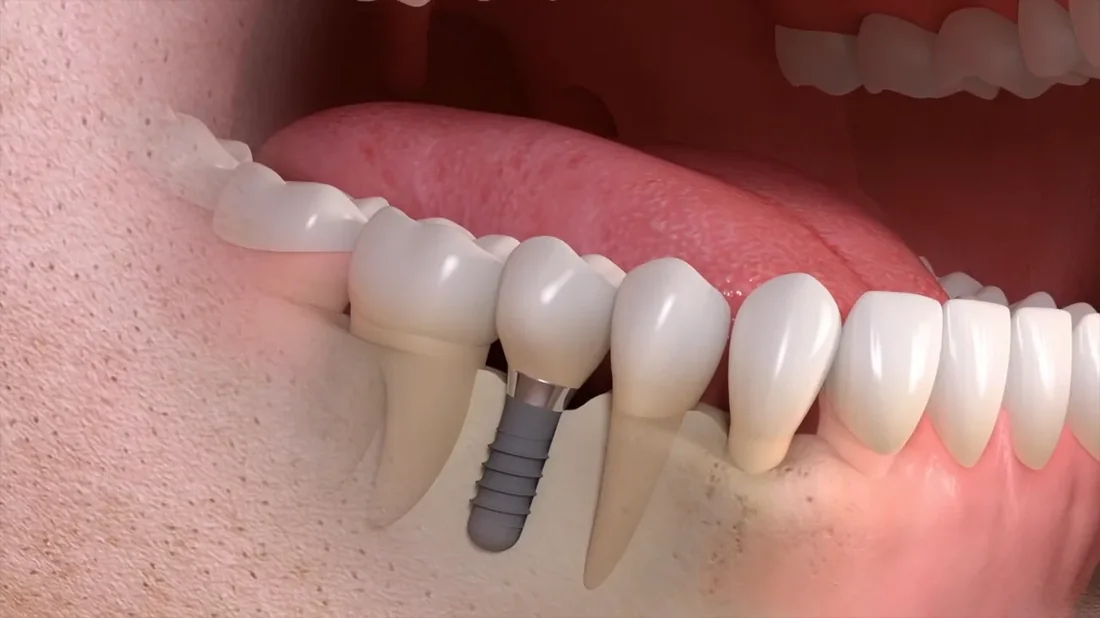 Render 3D de coroa cerâmica fixada sobre implante em boca aberta