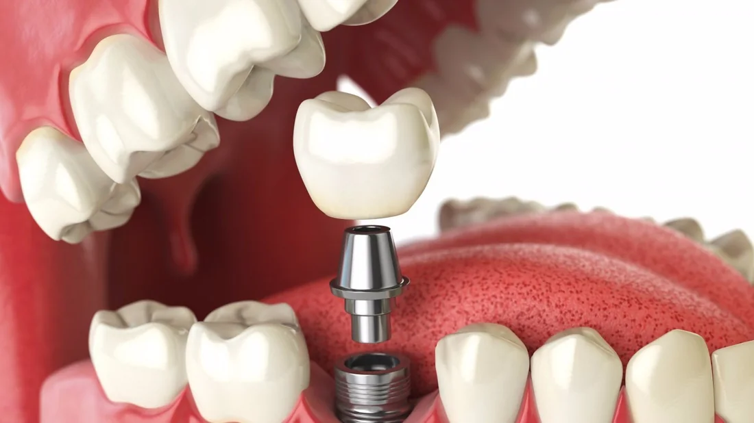 Render 3D de implante dentário unitário: coroa, abutment e parafuso na arcada