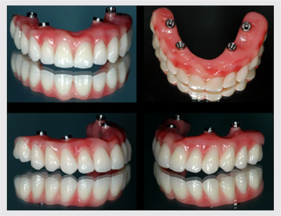 Foto real de prótese protocolo sobre implantes em quatro vistas